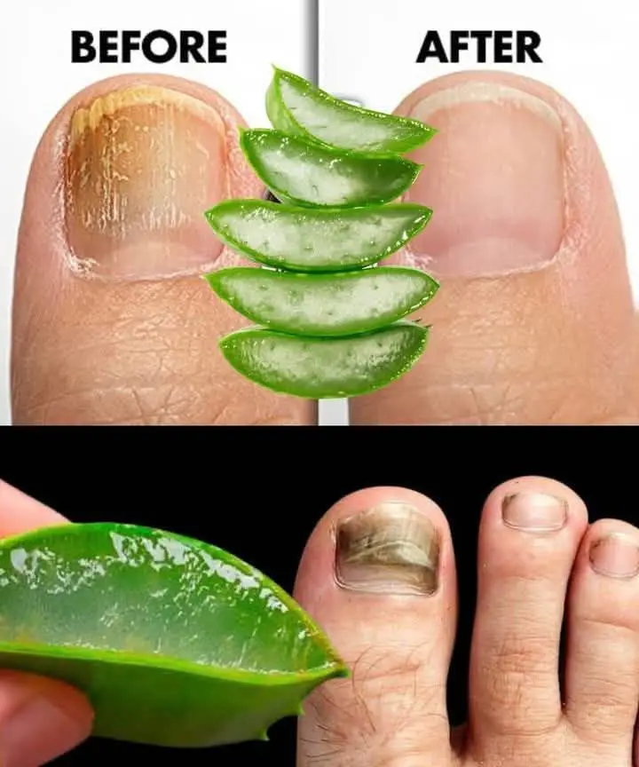 Aloe Vera Did THIS to My Toenails