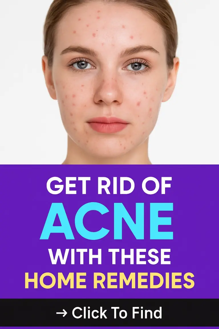 Get Rid of ACNE with THESE Home Remedies