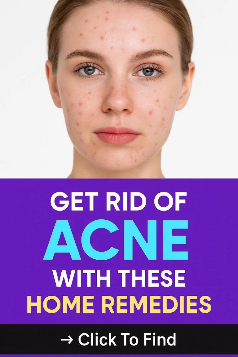 Get Rid of ACNE with THESE Home Remedies